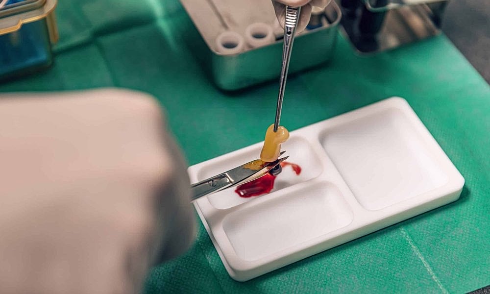 Platelet-Rich Fibrin (PRF) Therapy: What It Is and How It Works