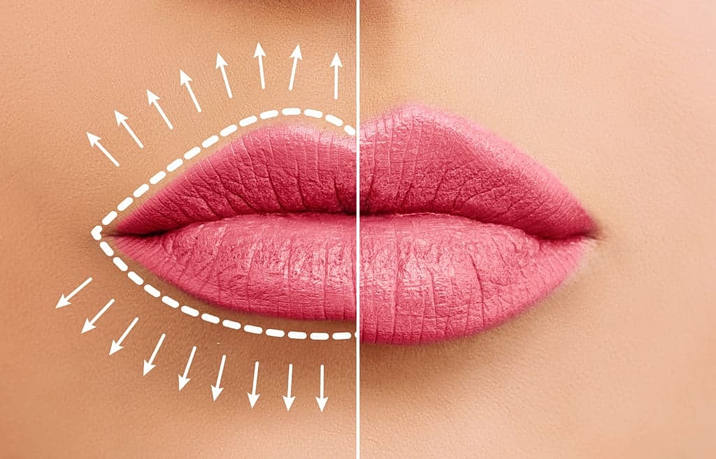 Lip enhancement technique illustrated on model's lips.