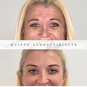 Botox Gallery Before & After
