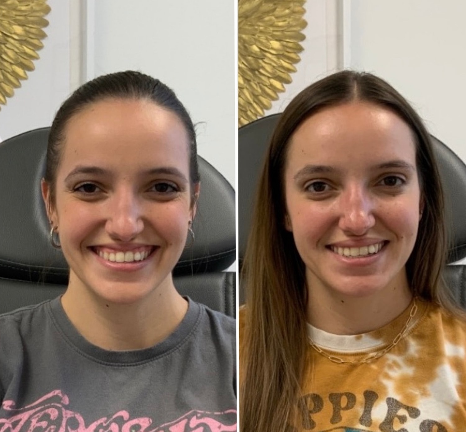 Botox Gallery Before & After